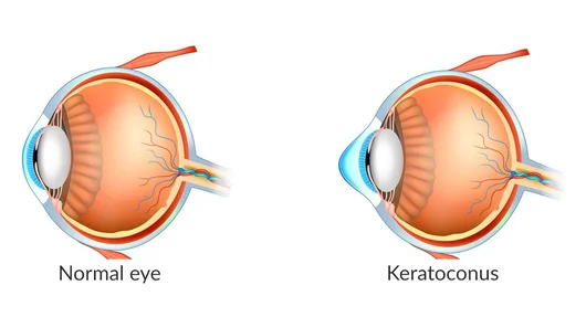 Diagram showing corneal changes in keratoconus